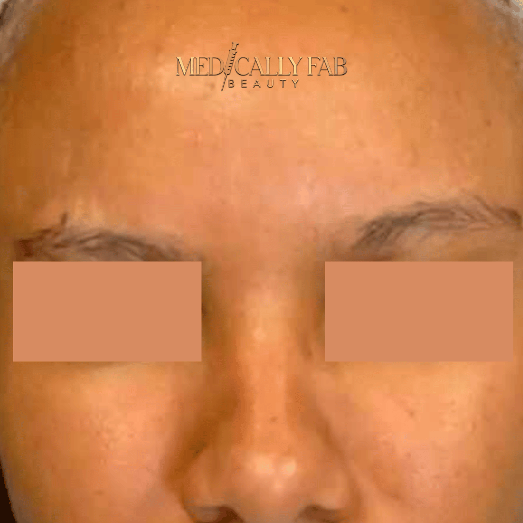 Botox Results