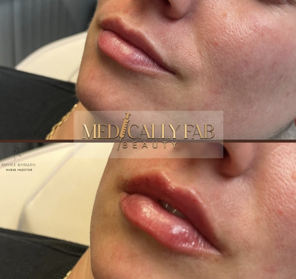 This is a picture of a woman before and after she received lip filler from medically fab beauty.