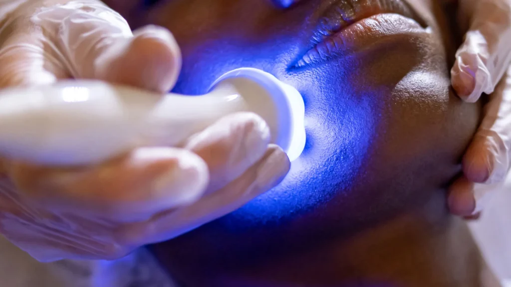 This is a photo of a black woman getting laser hair removal on her face which is one of the esthetic treatments that we recommend in the winter season.