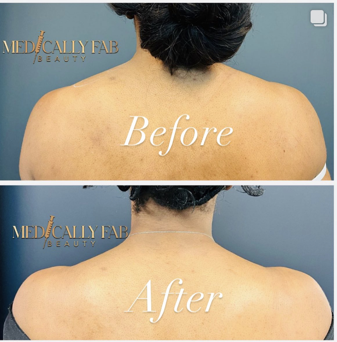 Before and After Image: Barbie Tox, Trapezius Muscle Tox - front