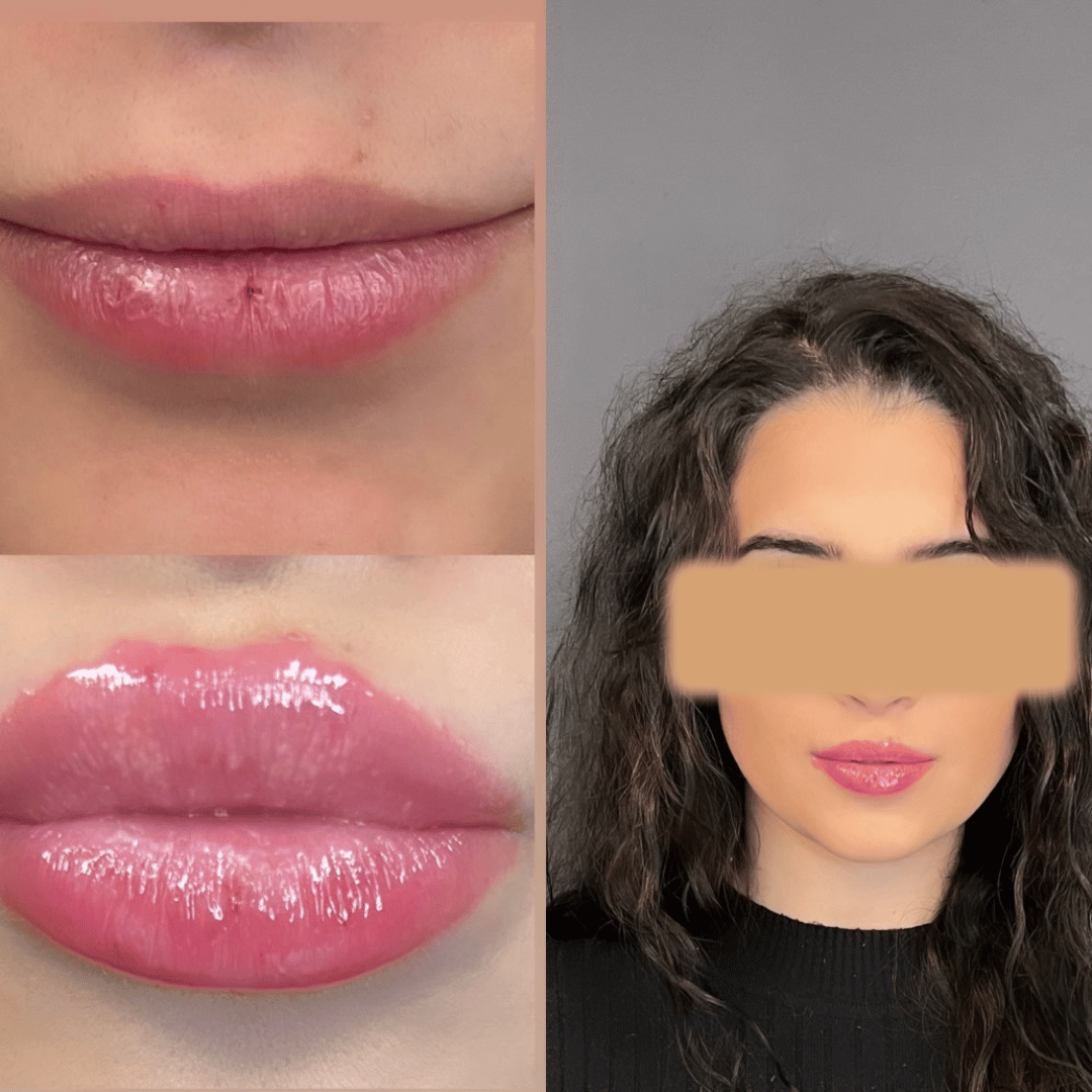 Before and After Image: Lip Filler - front