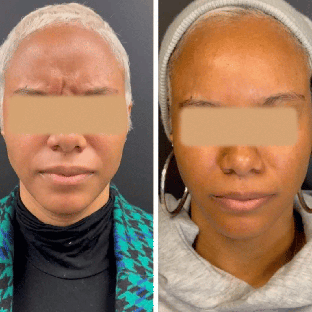 Before and After Image: Botox - front