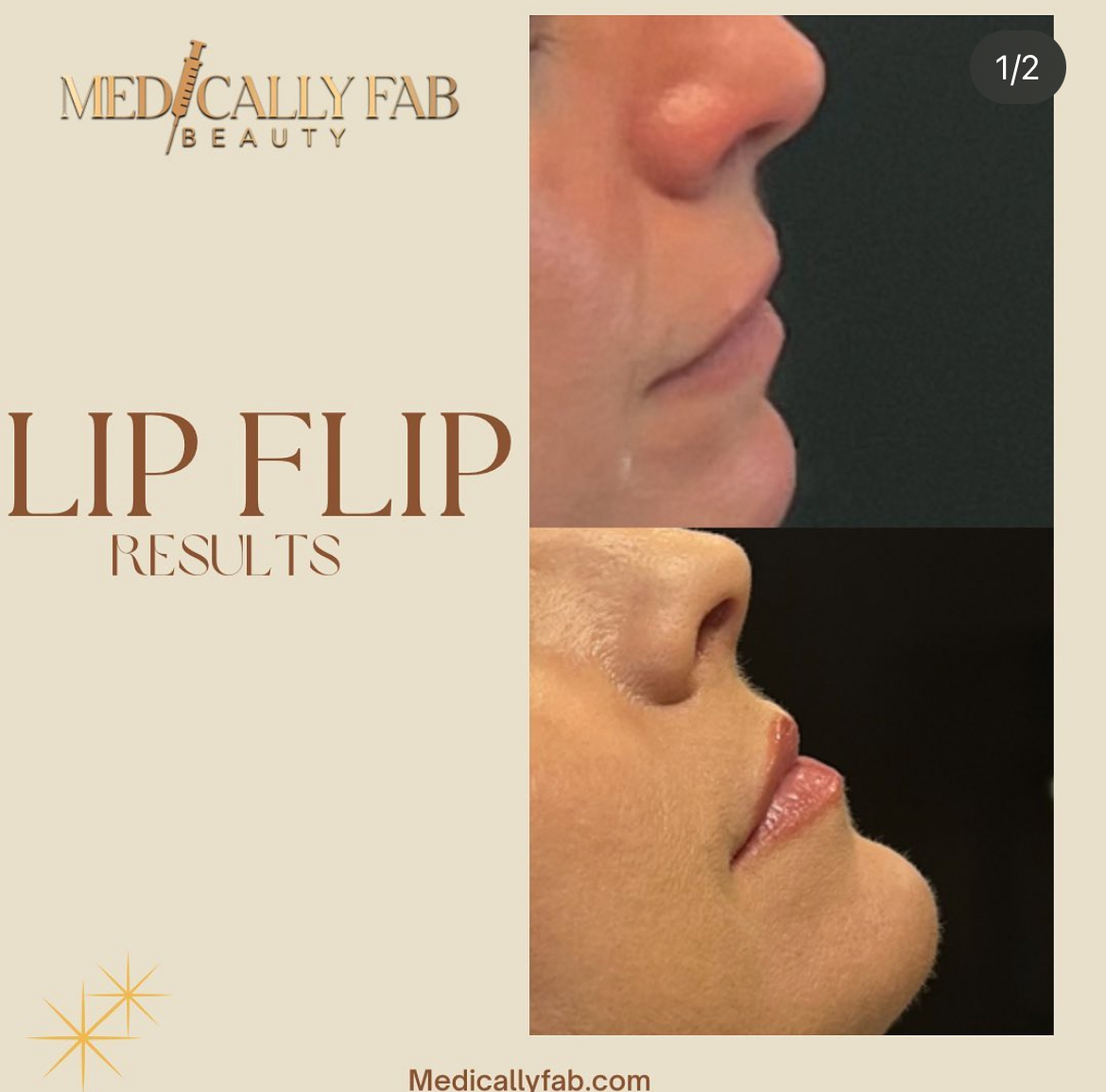 Before and After Image: Botox Lip Flip - right-side