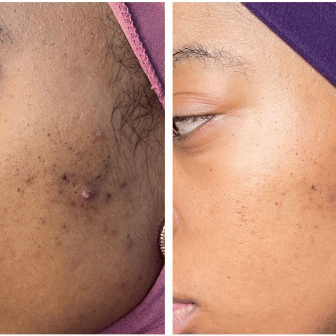 Before and After Image: Chemical Peel with VI Peel - left-front-oblique