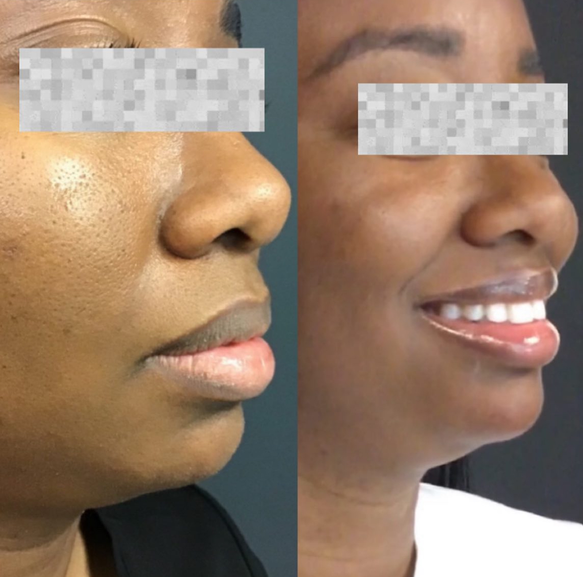 Before and After Image: Chin Filler - right-front-oblique