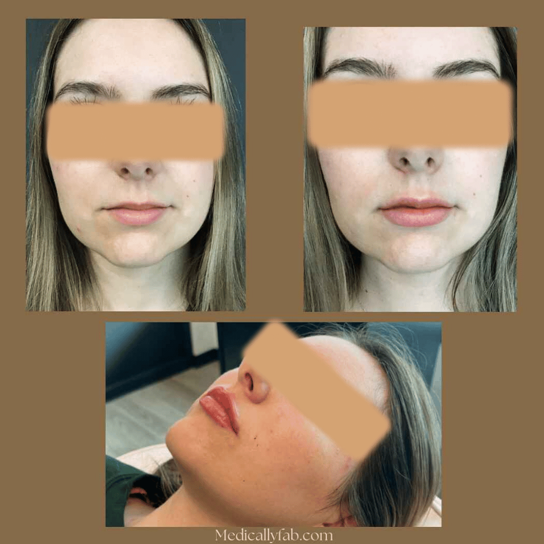 Before and After Image: Juvederm Ultra Lip Filler - front