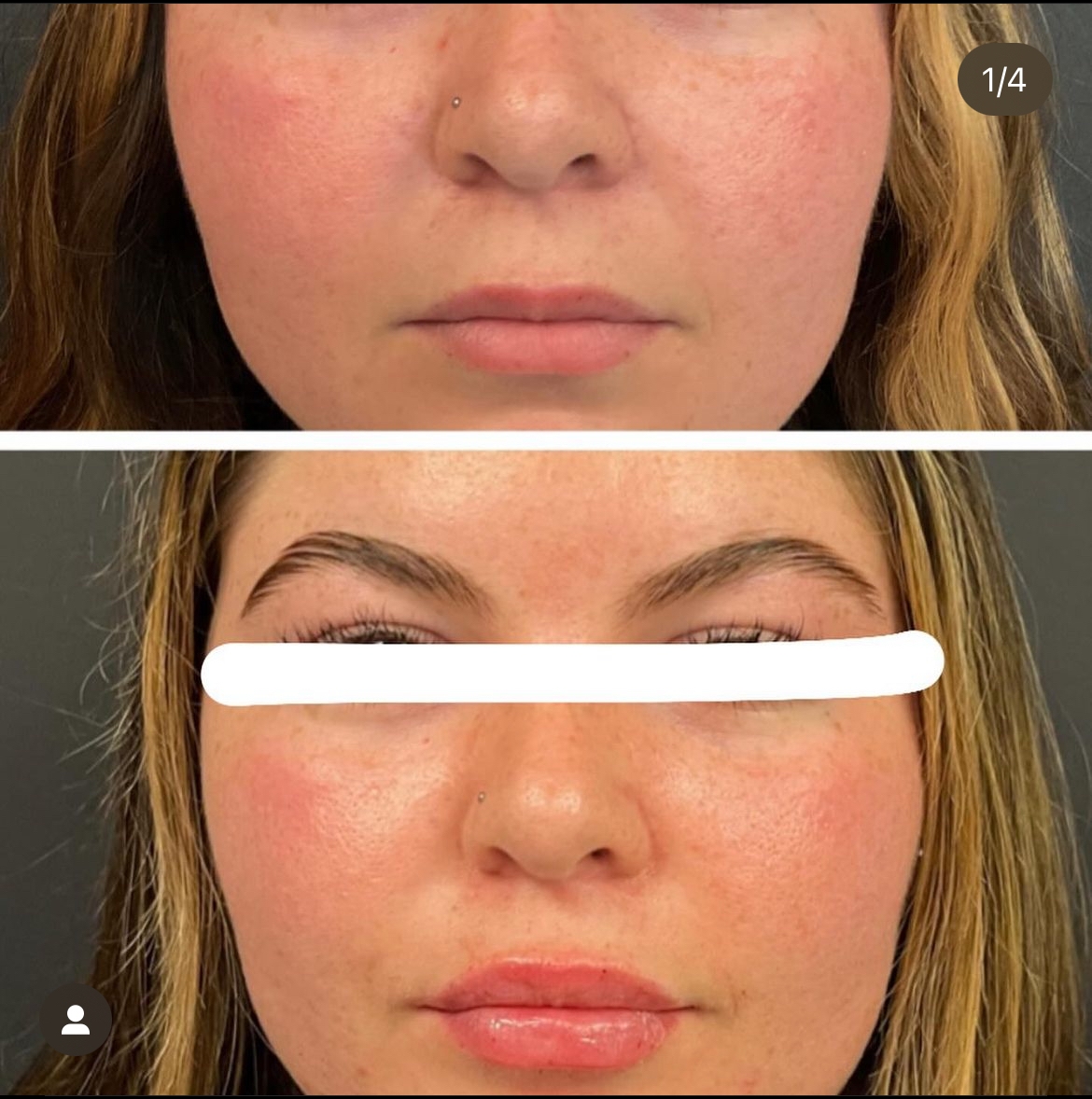 Before and After Image: Lip, Cheek, Chin Fillers - front