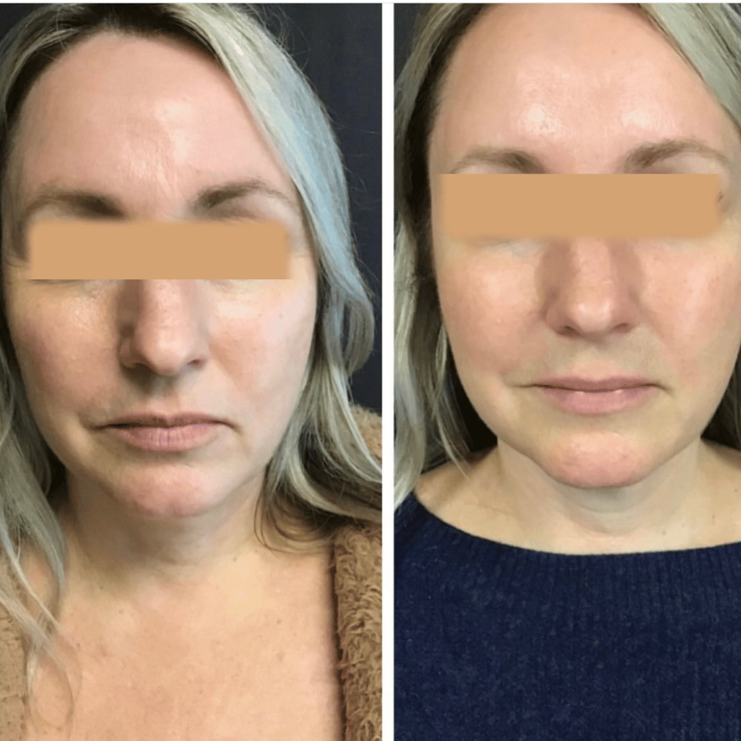 Before and After Image: Mild Brow Lift and Mild Nasal Tip Rotation - front