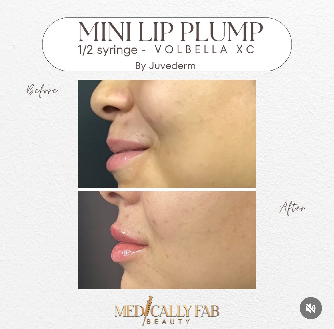 Before and After Image: Mini Lip Plump – Juvederm Volbella - left-side