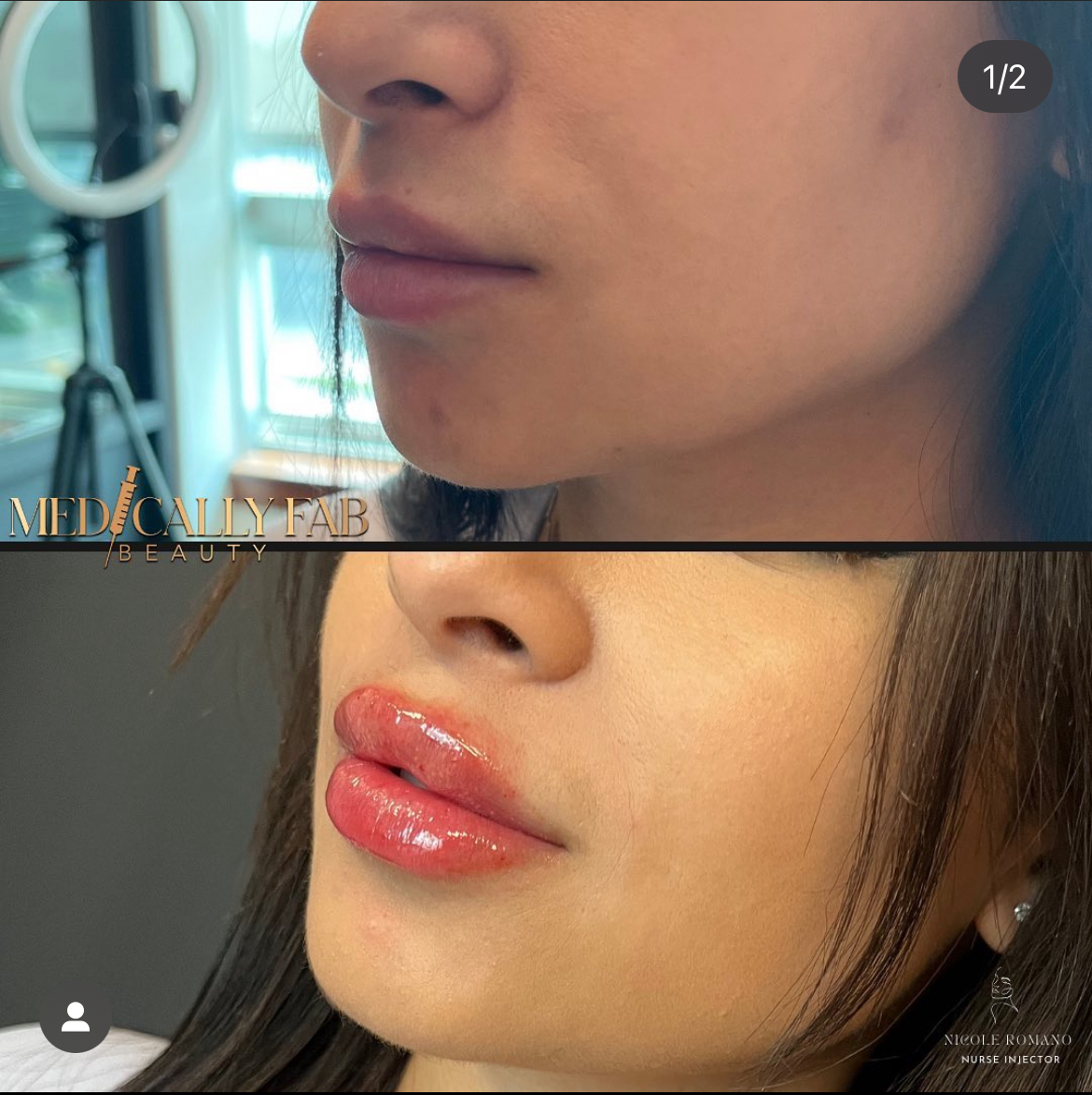 Before and After Image: Restylane Kysse - left-front-oblique