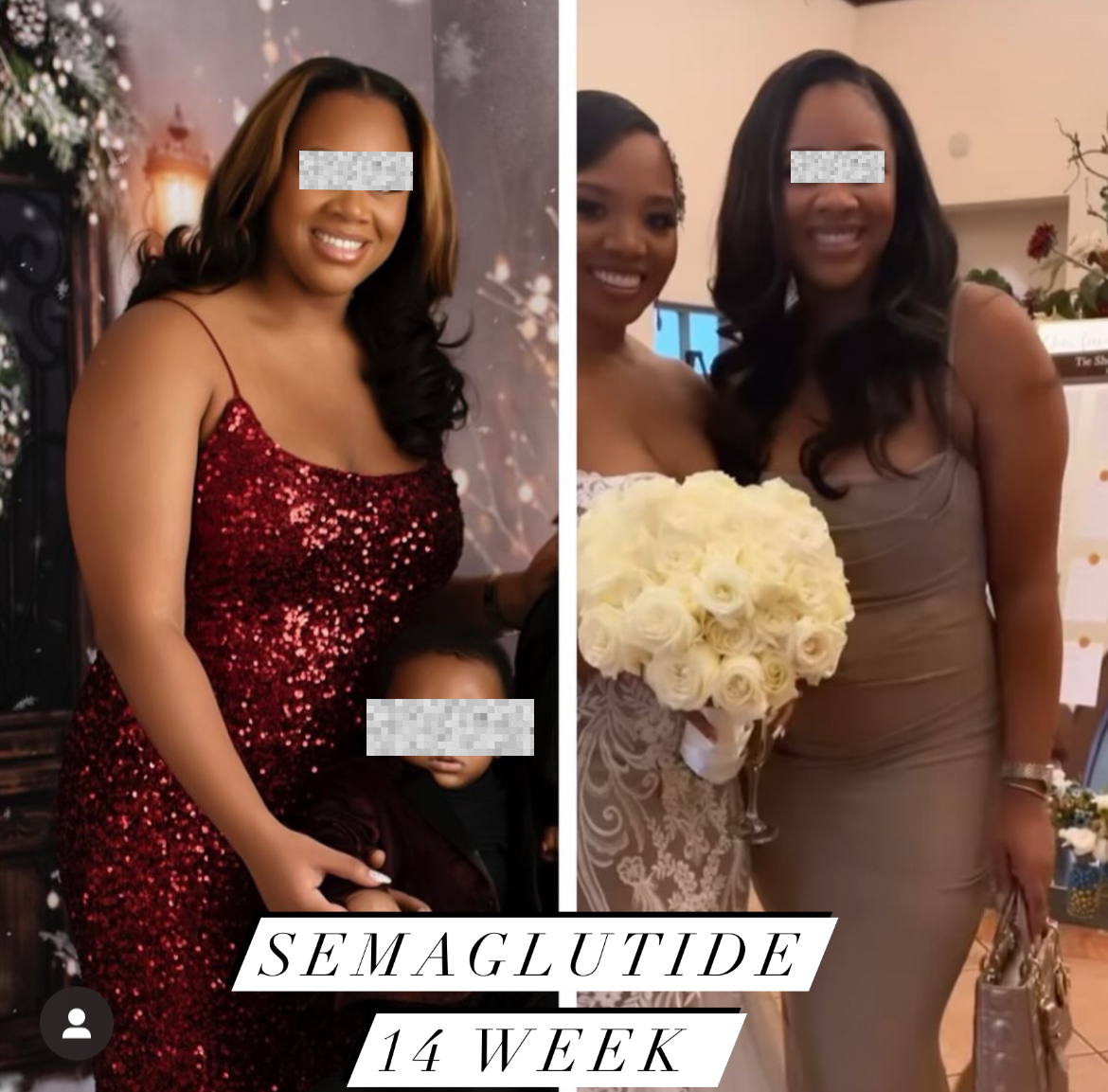 Before and After Image: Semaglutide Weight Loss - front