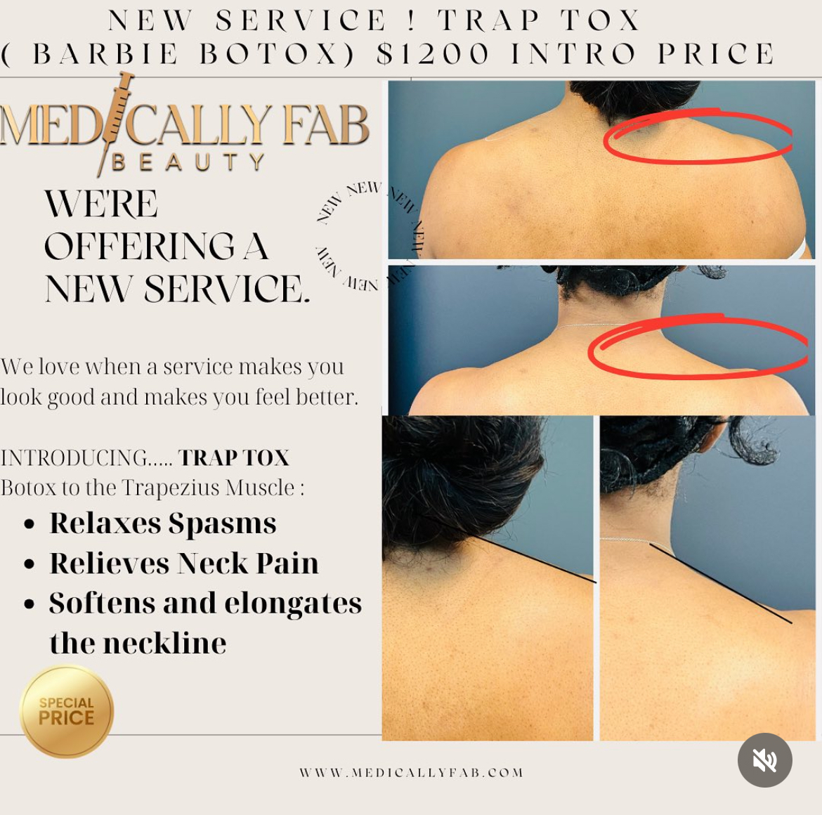 Before and After Image: Barbie Botox, Trapezius Muscle Tox - front